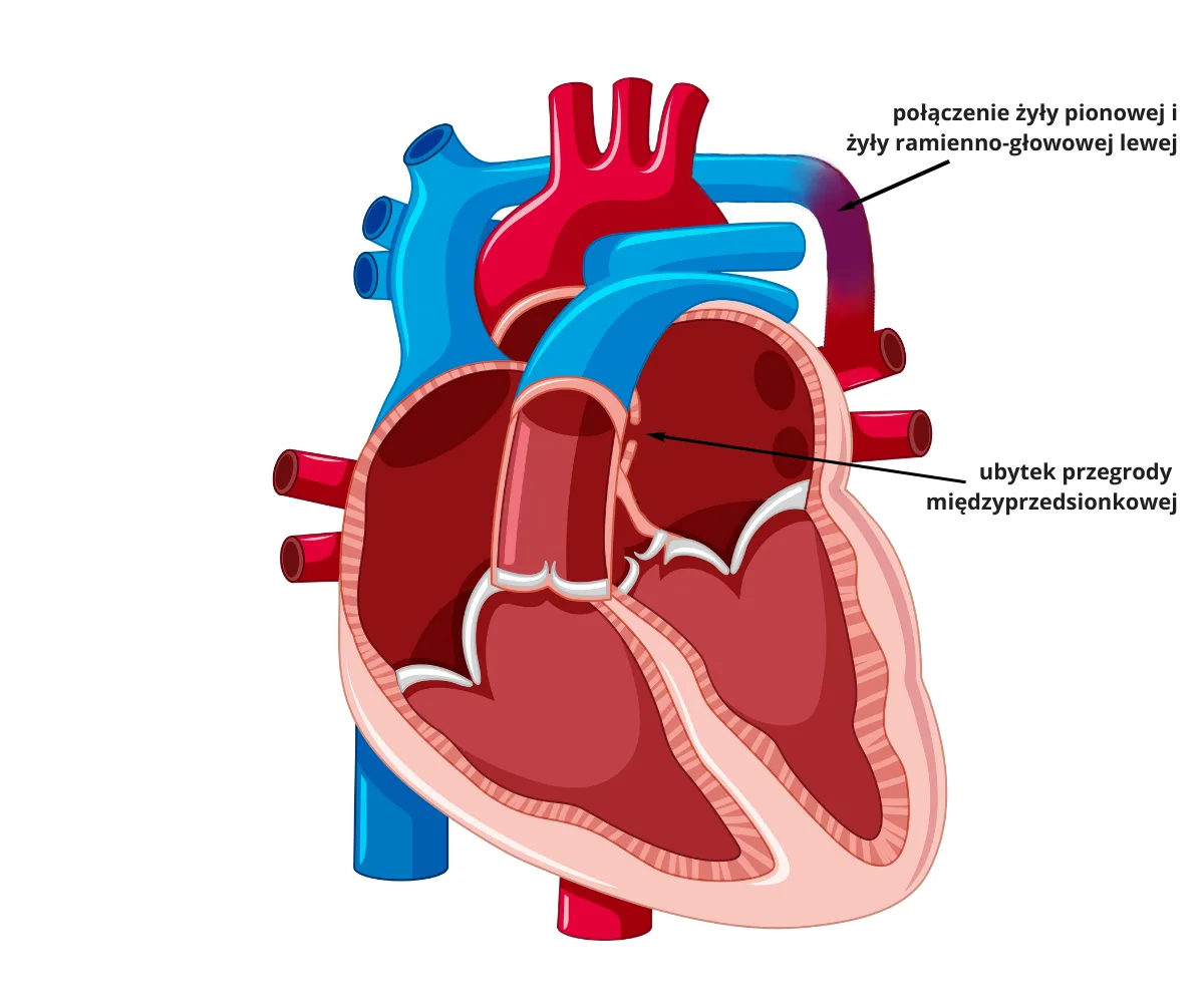 Całkowite nieprawidłowe połączenie żył płucnych (TAPVC)